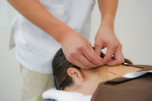 鍼治療を受ける女性